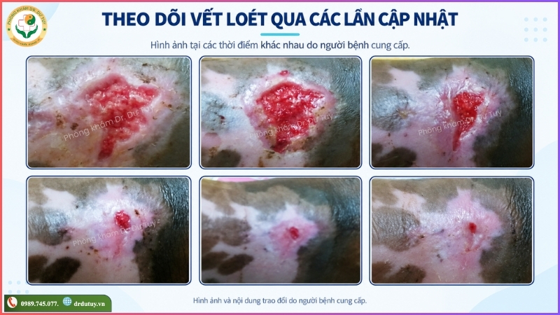 theo-doi-vet-loet-qua-cac-lan-cap-nhat (1)